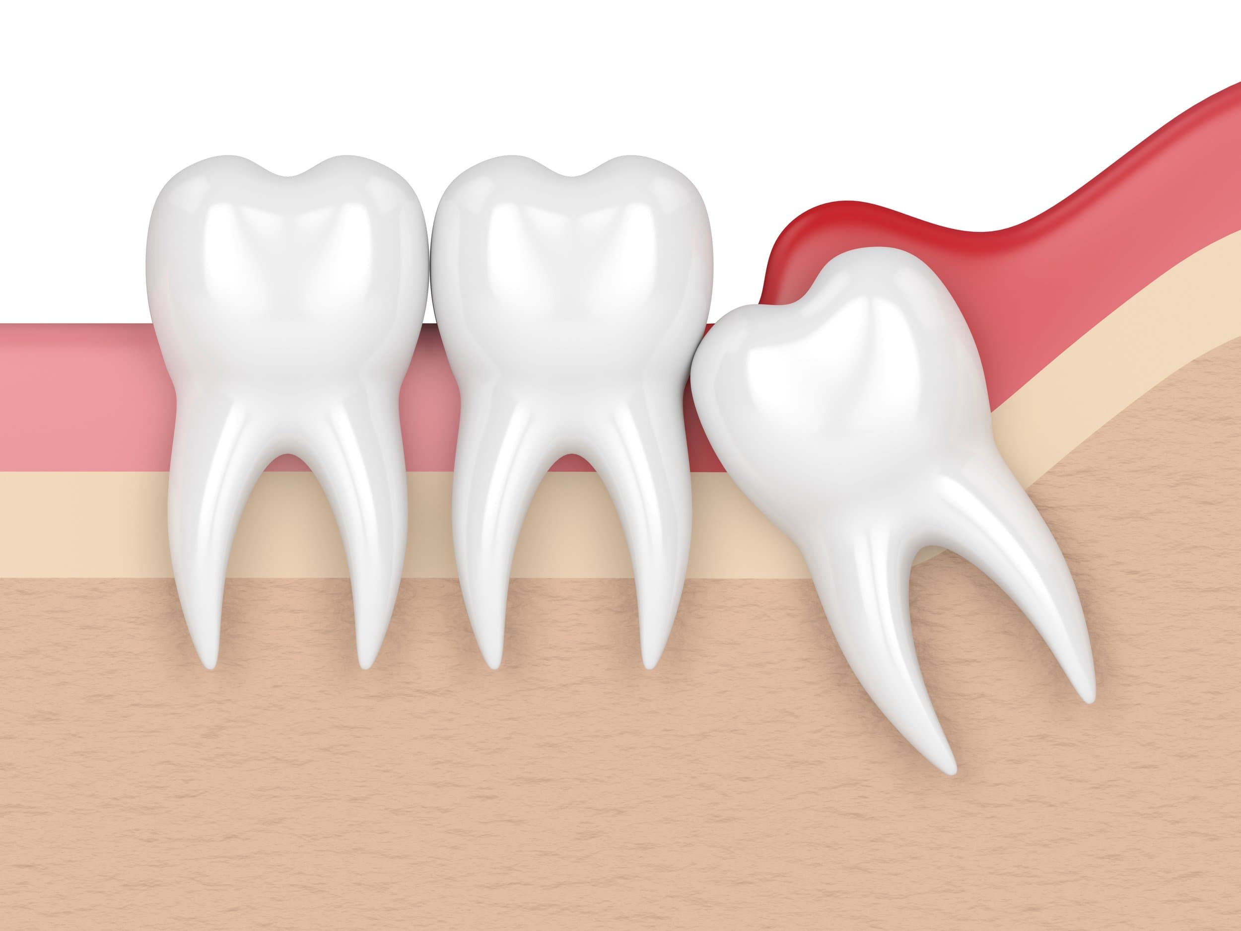 3D render of an impacted wisdom tooth causing pericoronitis at Align Dental Surgery