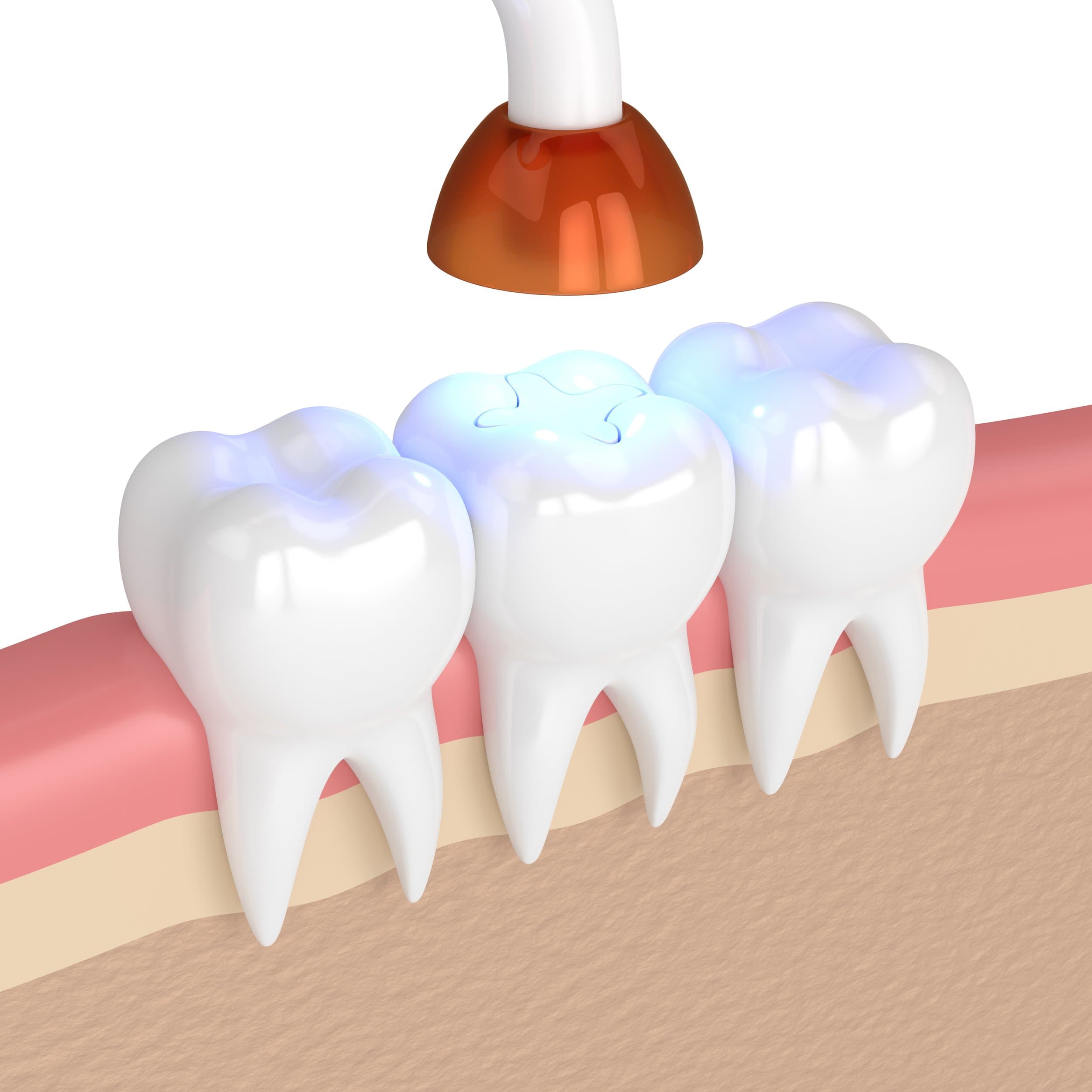 3D render of teeth being treated with a dental curing lamp at Align Dental Surgery