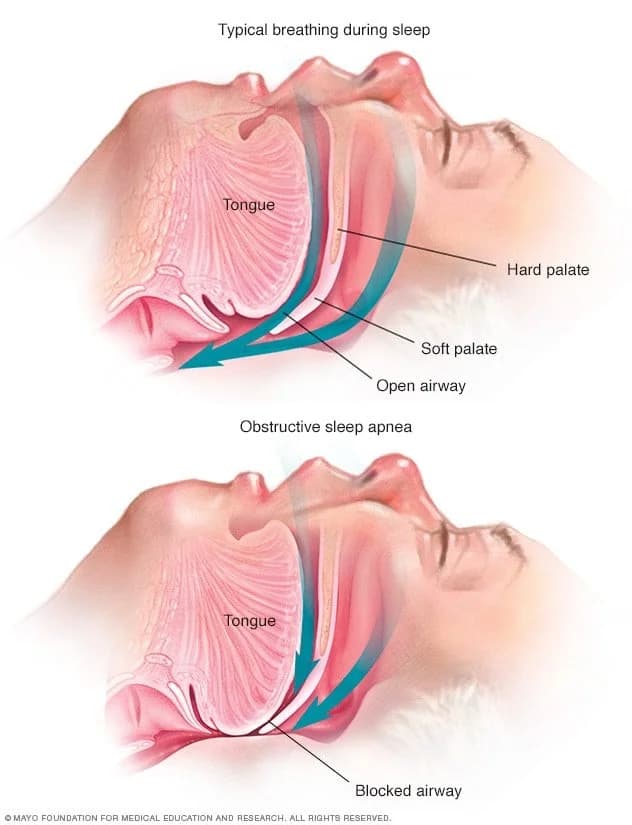 A diagram comparing an open airway during typical sleep with a blocked airway in obstructive sleep apnea at Align Dental Surgery