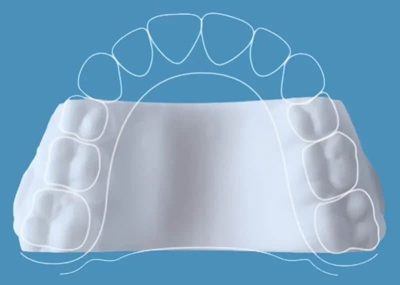 A 3D illustration of the upper dental arch with the clear Invisalign Palatal Expander seated over the teeth, viewed from below, at Align Dental Surgery