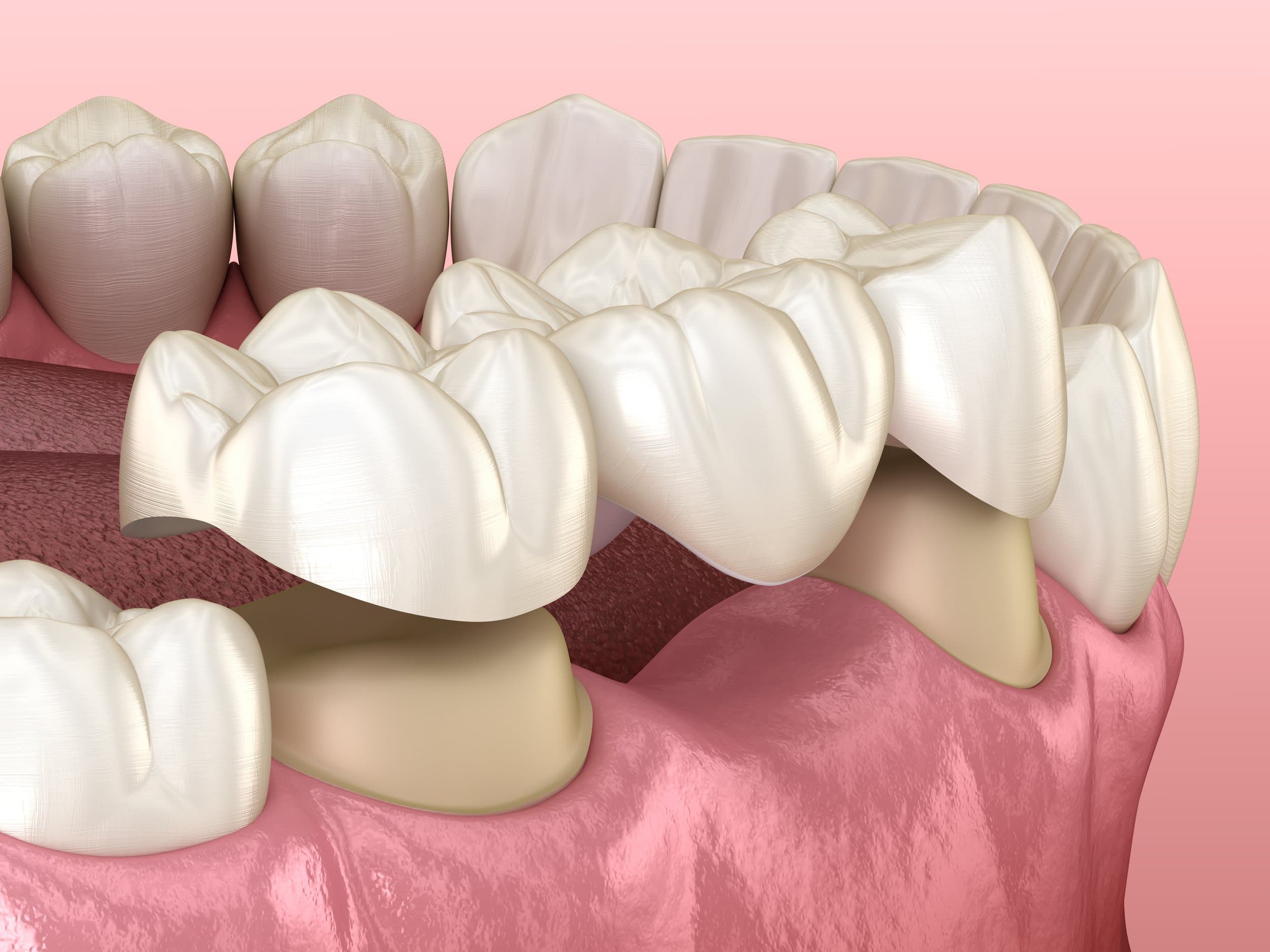 3D illustration of a dental bridge over a molar and premolar at Align Dental Surgery