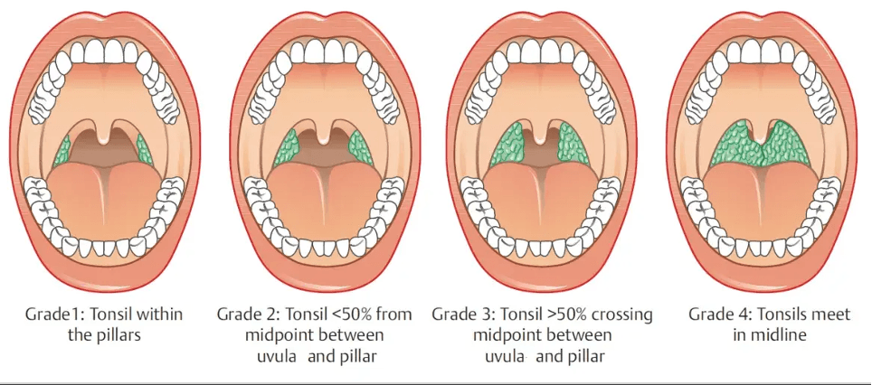 Brodsky tonsil grading scale illustration showing Grade 1 to Grade 4 tonsil enlargement