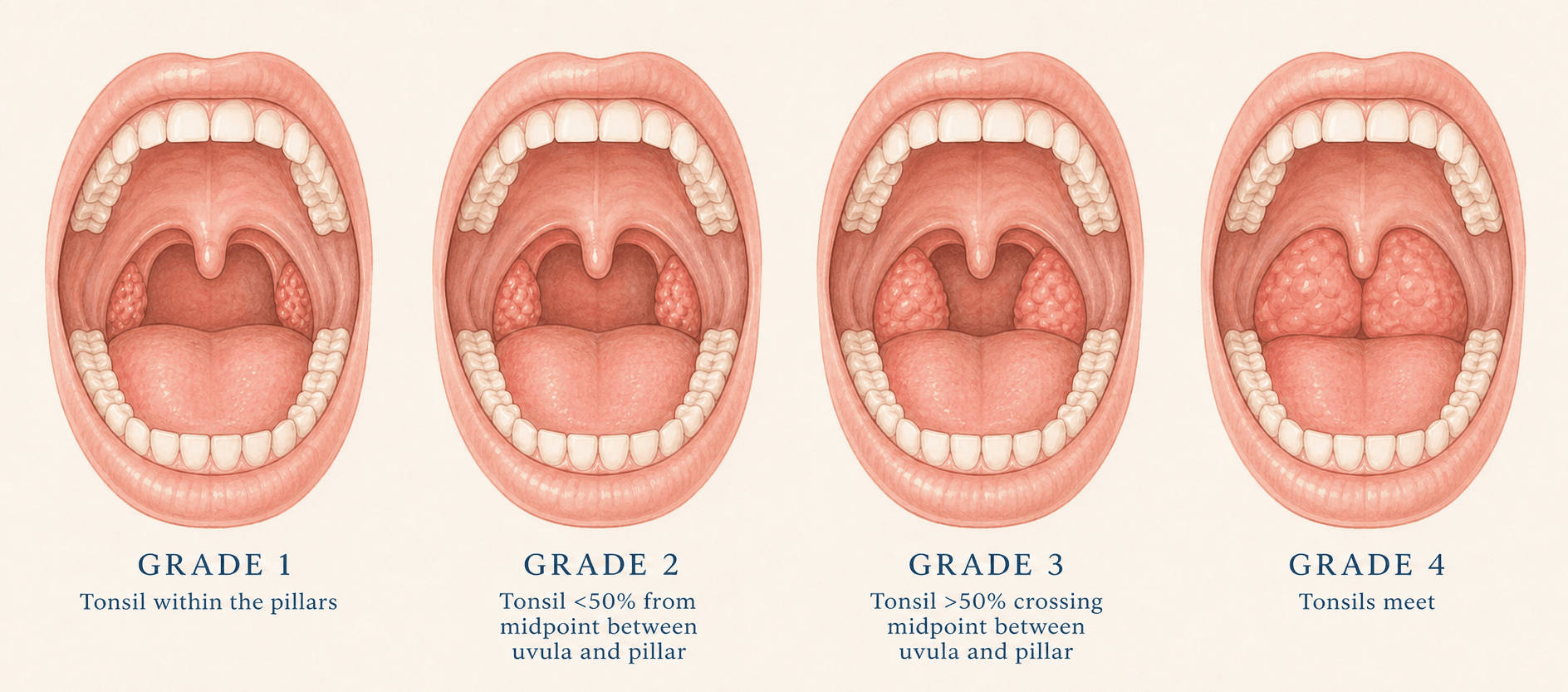 Brodsky tonsil grading scale illustration showing Grade 1 to Grade 4 tonsil enlargement