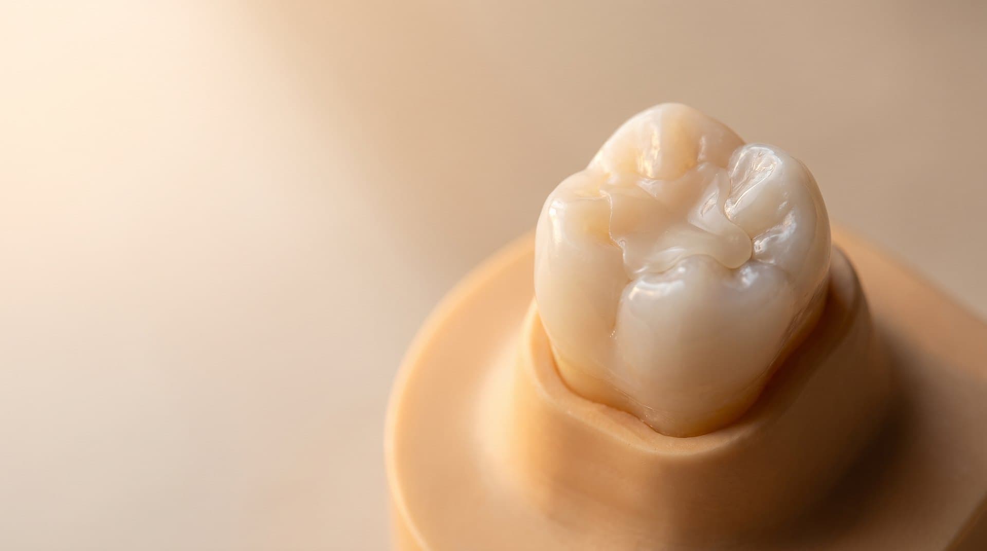 A close-up photograph of a molar restored with a tooth-coloured composite resin filling