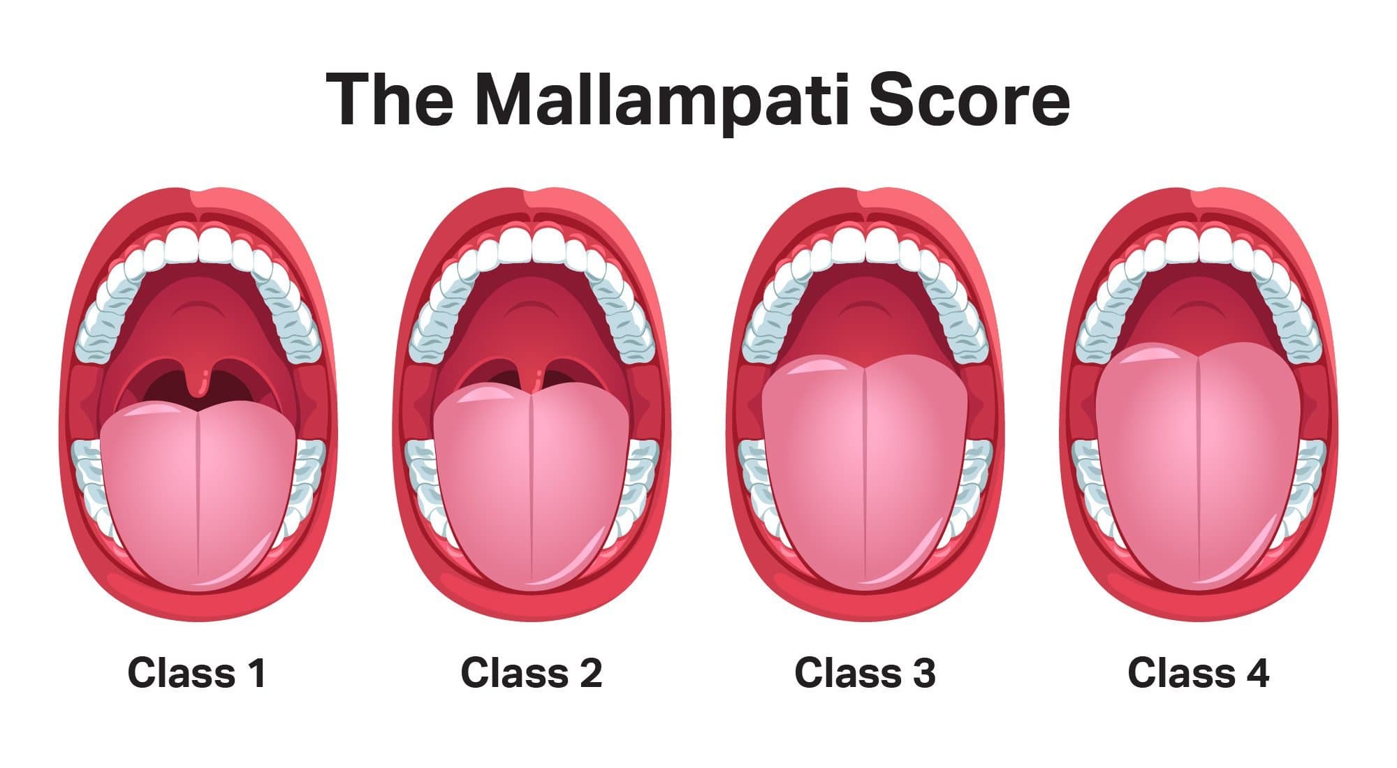 Mallampati score illustration showing Class 1 to Class 4 visibility of the throat behind the tongue