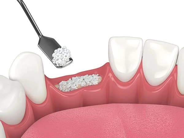 Dental bone graft material used to rebuild lost jawbone at Align Dental Surgery