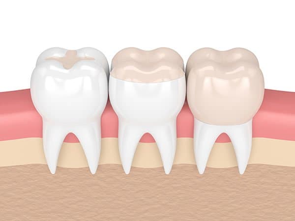 A tooth-coloured composite filling matched to a natural tooth at Align Dental Surgery