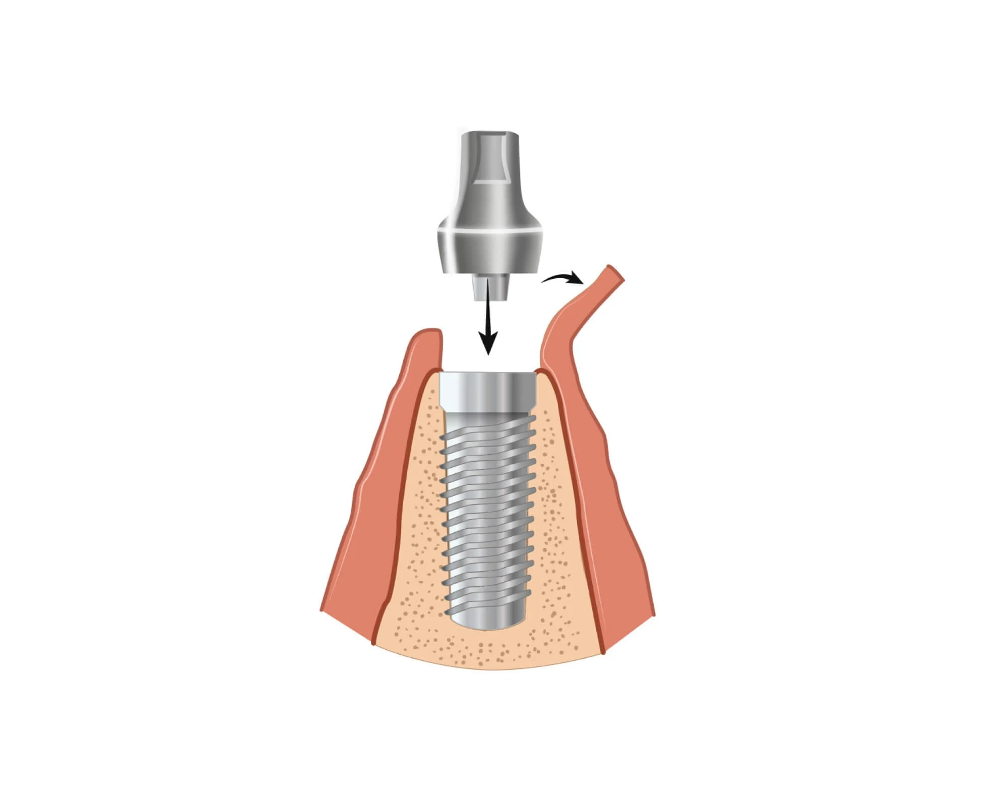Diagram of an abutment attached to a dental implant at Align Dental Surgery