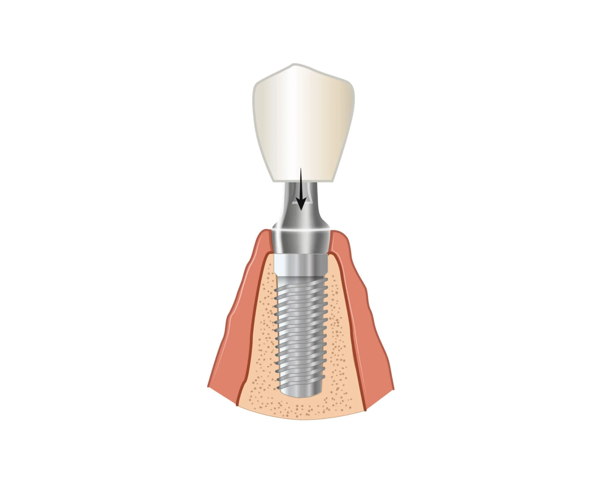 Diagram of a crown fitted onto a dental implant at Align Dental Surgery