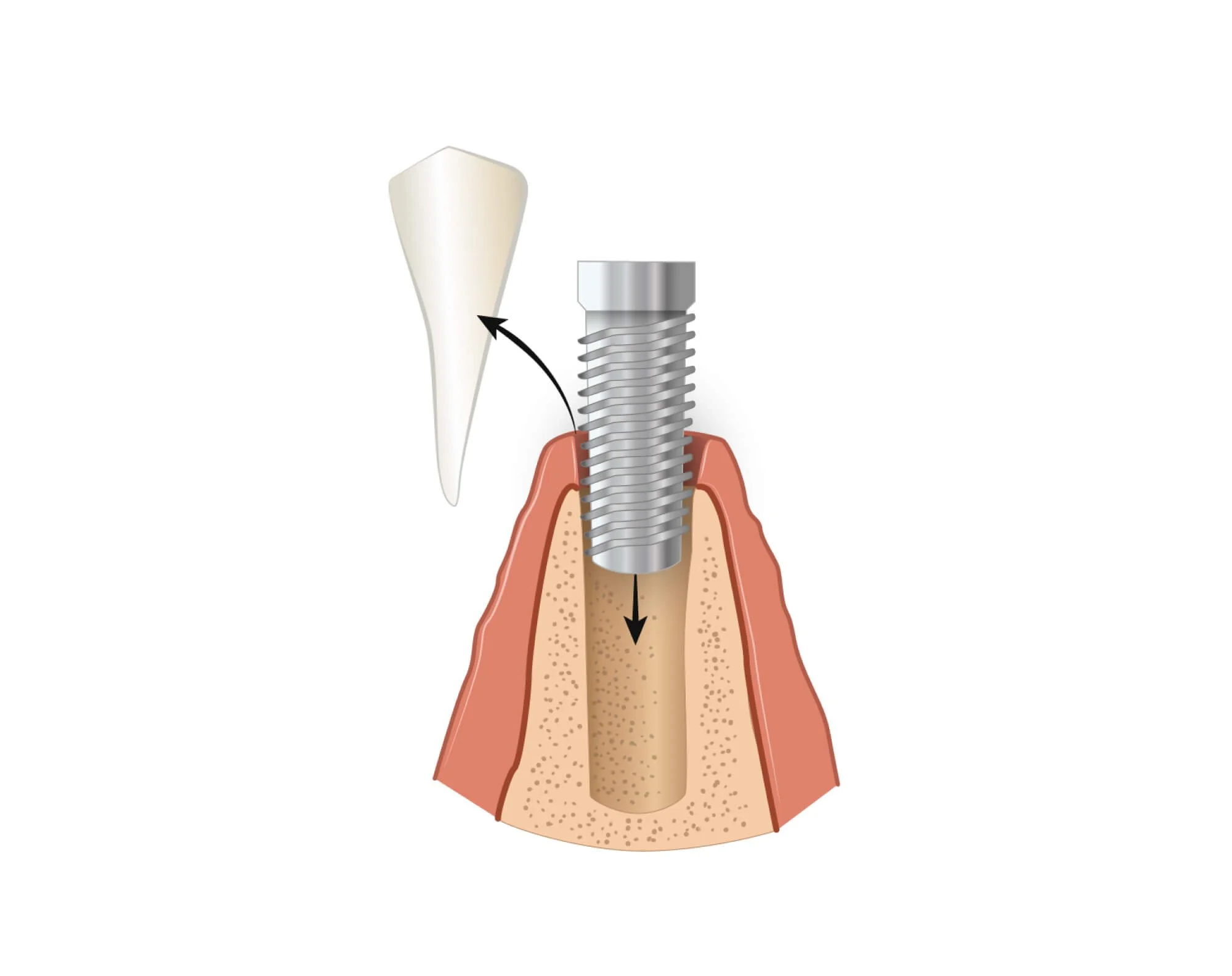 Diagram of a titanium implant fixture inserted into the jawbone at Align Dental Surgery