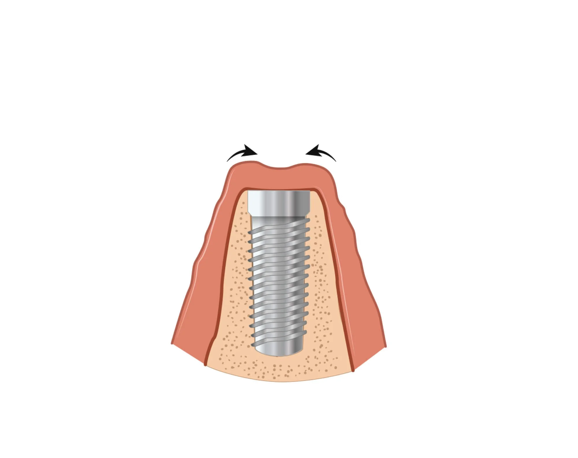 Illustration of a dental implant fusing with the jawbone at Align Dental Surgery
