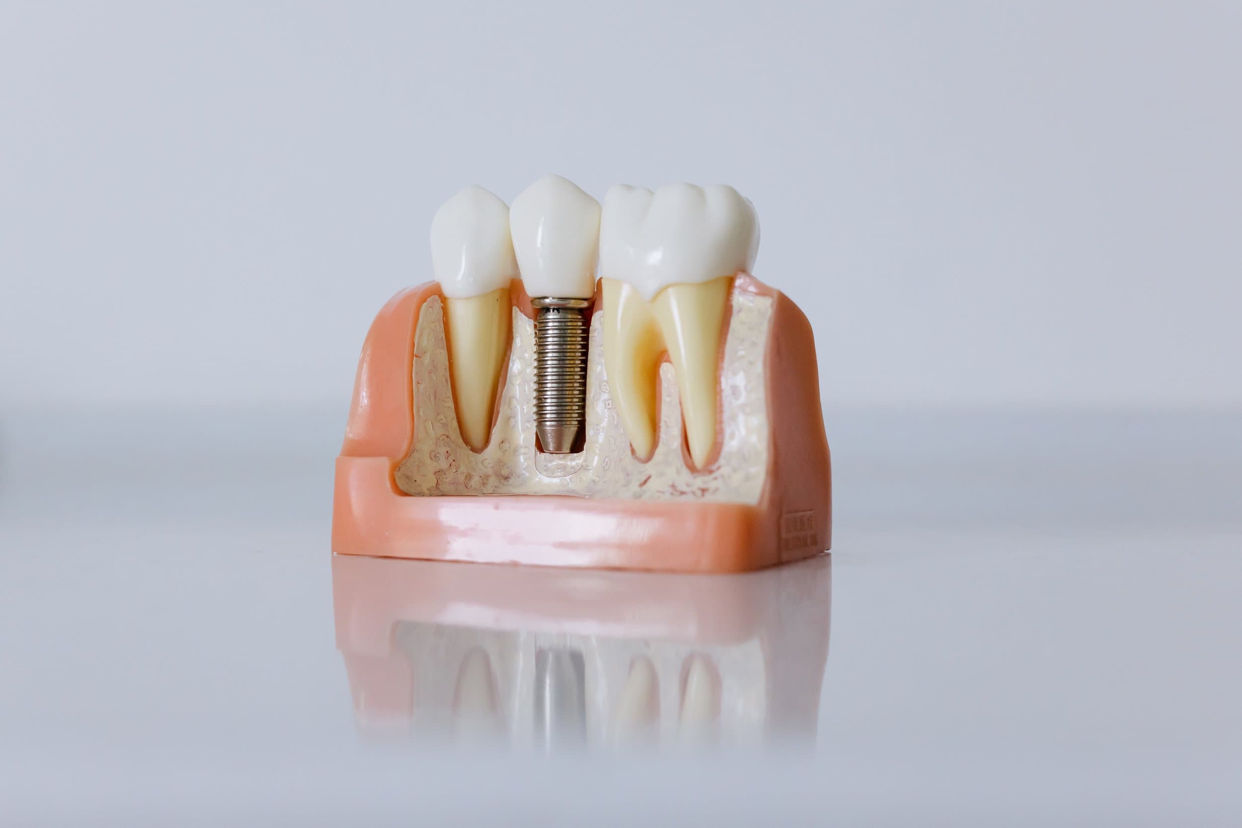 A dental implant model showing the titanium post in the jawbone at Align Dental Surgery