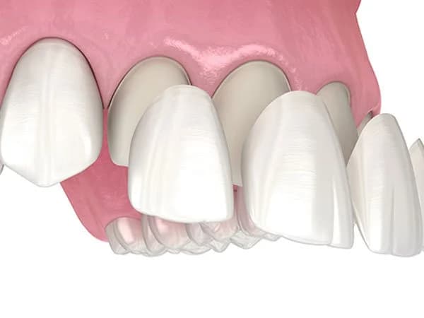 Dental veneers used to cover deep tooth stains at Align Dental Surgery