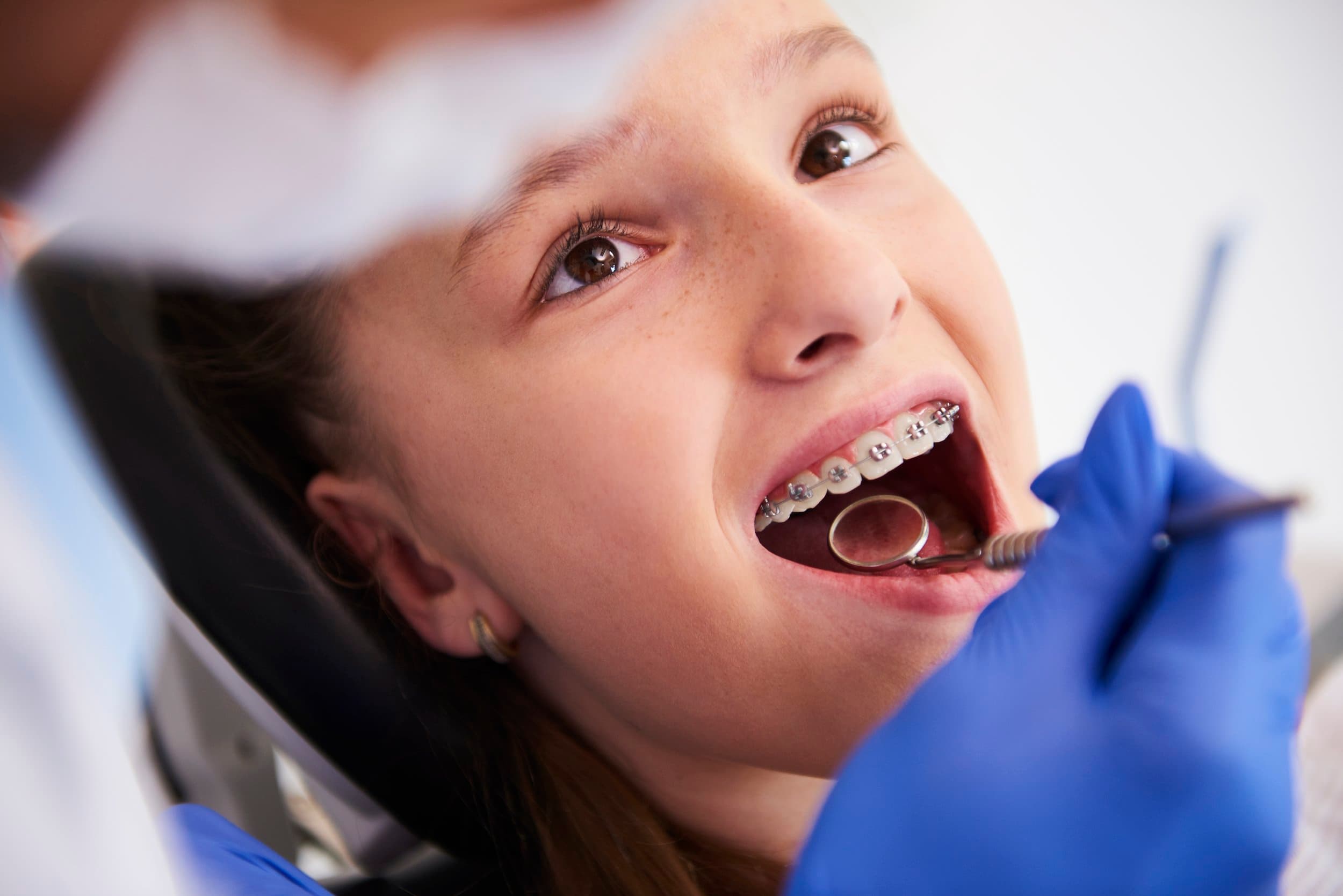 A girl smiling with fixed braces at Align Dental Surgery