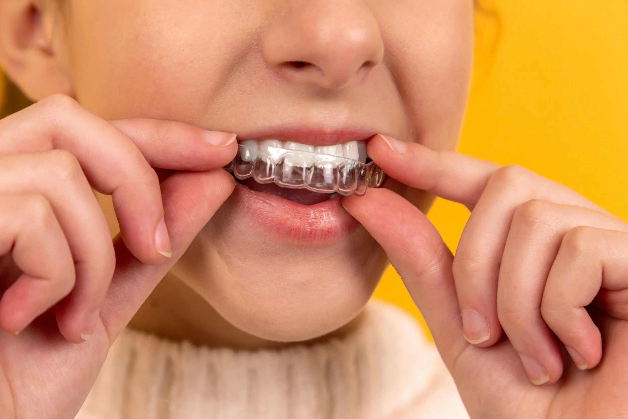 A clear Invisalign First aligner being placed, at Align Dental Surgery, Orchard Road