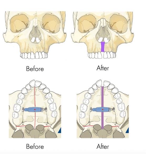 Before and after diagrams of a narrow upper jaw widened by palatal expansion at Align Dental Surgery