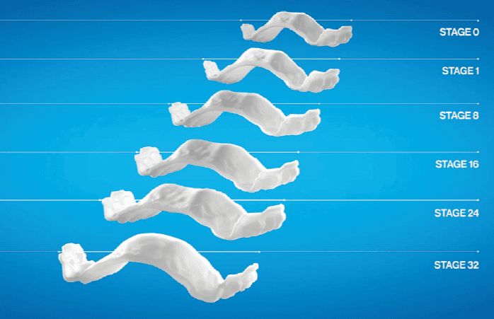 A diagram of the Invisalign Palatal Expander widening progressively from stage 0 to stage 32, at Align Dental Surgery