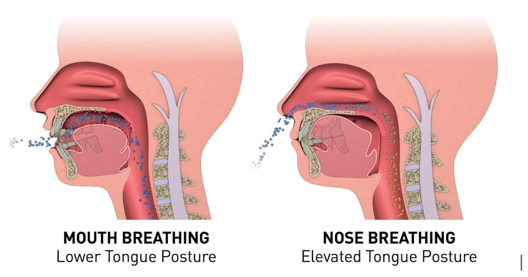 Diagram comparing ideal elevated tongue posture resting on the palate with low tongue posture, at Align Dental Surgery