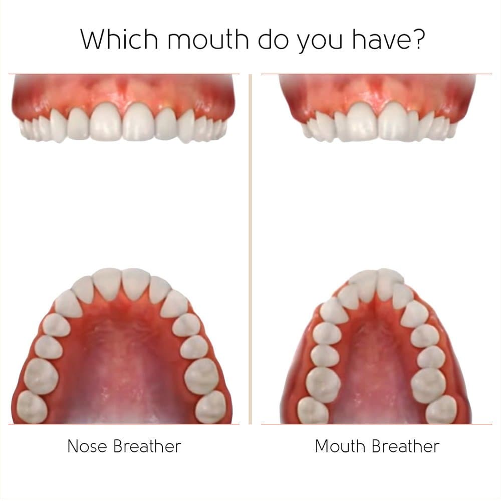 Diagram comparing a nose breather's broad U-shaped palate with a mouth breather's narrow V-shaped palate, at Align Dental Surgery