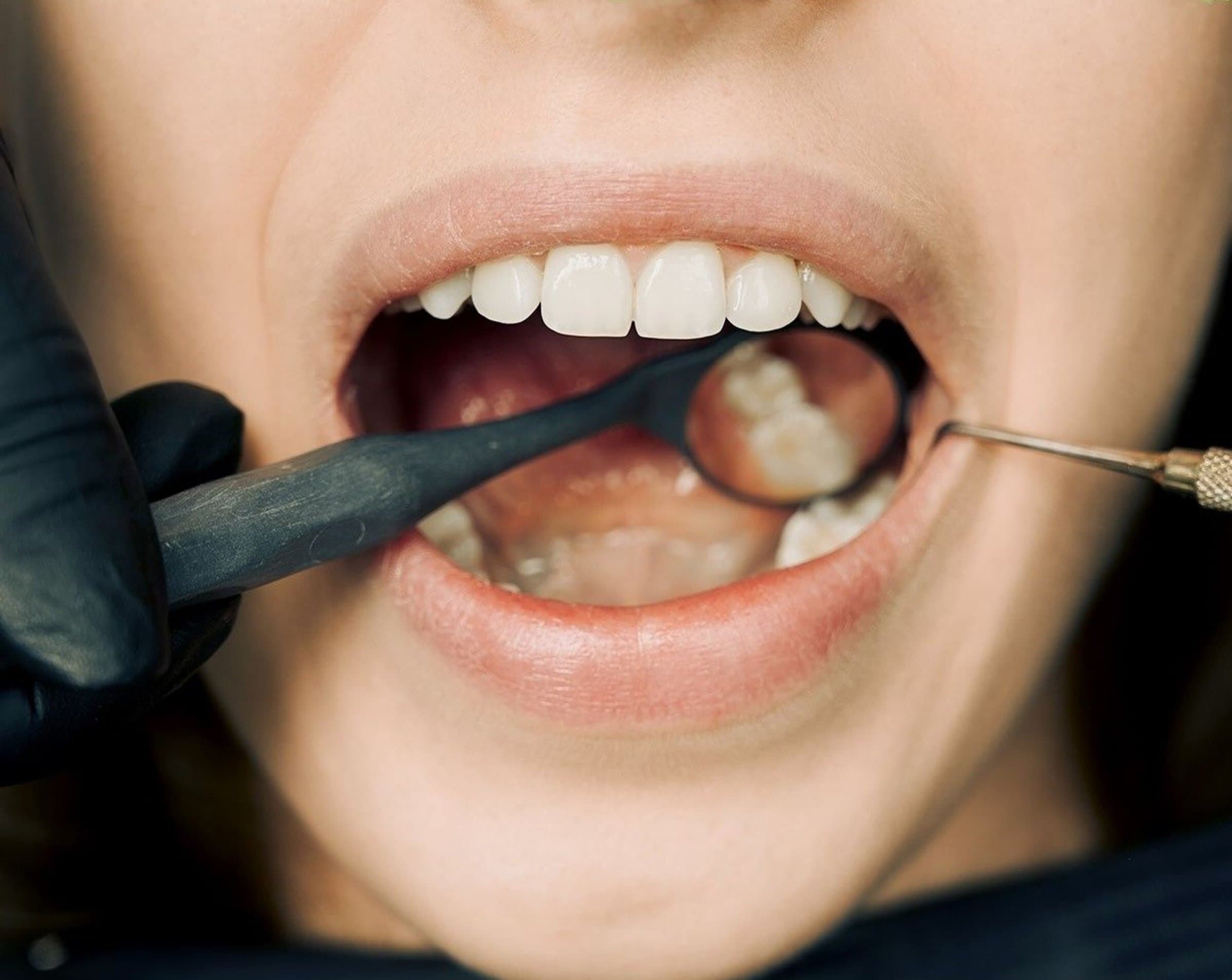Close-up of an open mouth during a dental examination at Align Dental Surgery