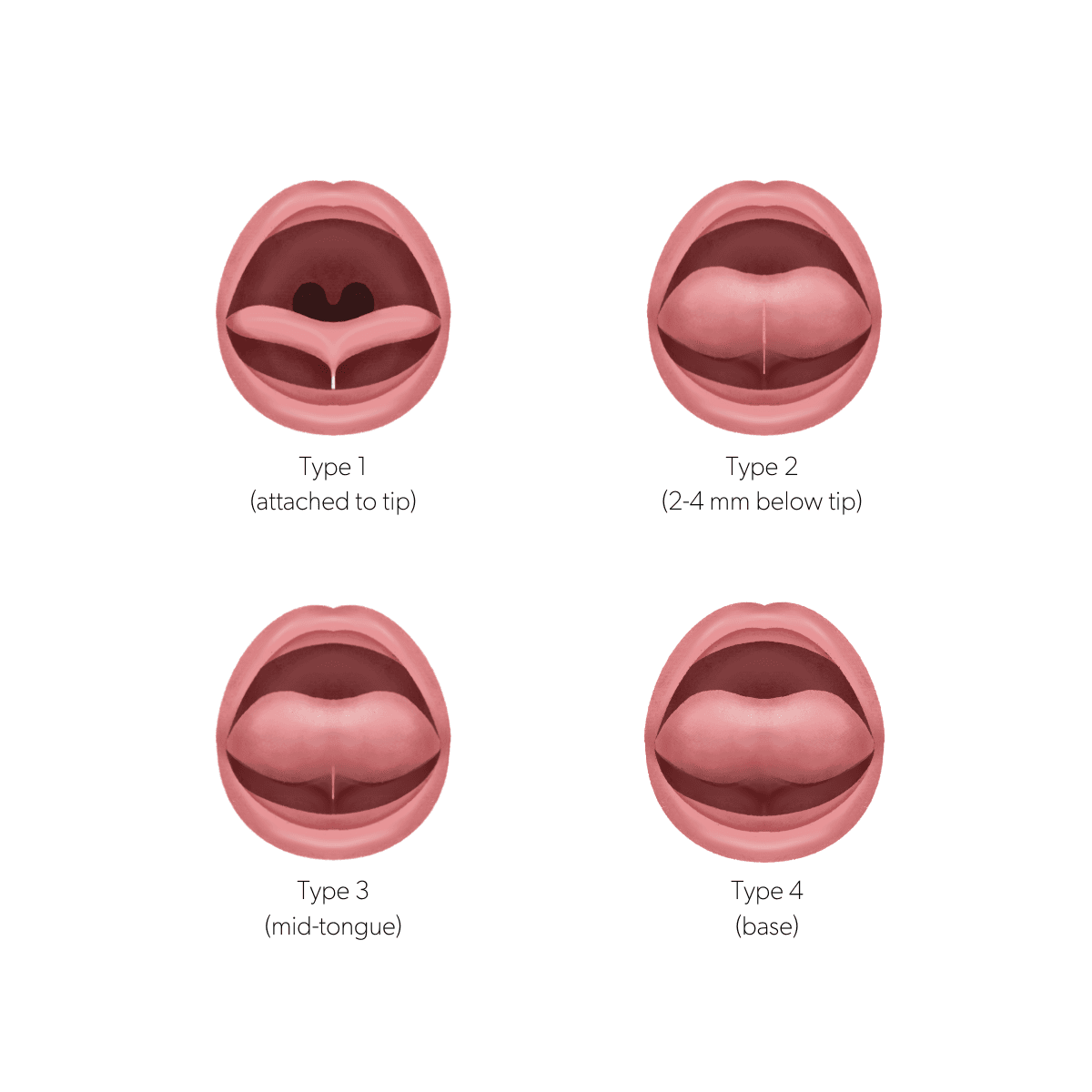 Tongue-tie (ankyloglossia) illustration showing Type 1 to Type 4 by point of tongue attachment
