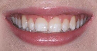 White spots on teeth that can be treated with ICON resin infiltration at Align Dental Surgery